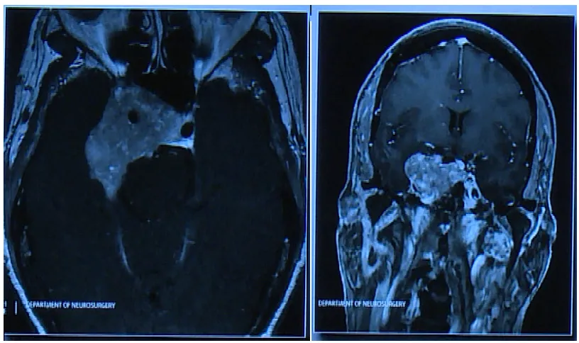 垂體瘤案例圖片